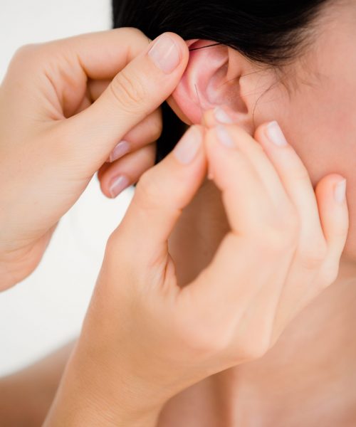 Woman holding a needle in an acupuncture therapy 534796